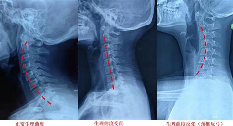 反弓|颈椎反弓越来越常见，严重还会引起瘫痪？